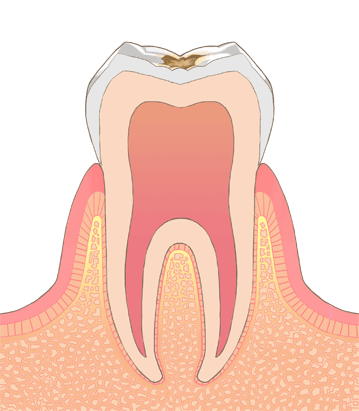 エナメル質のむし歯C1