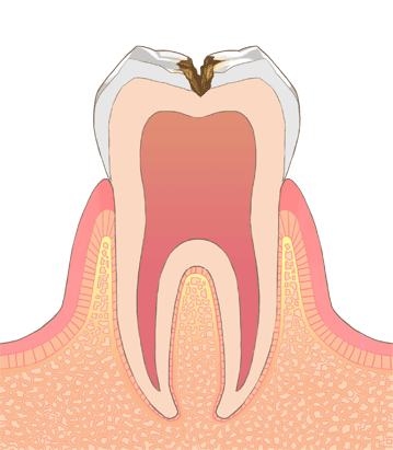 象牙質まで進んだむし歯C2